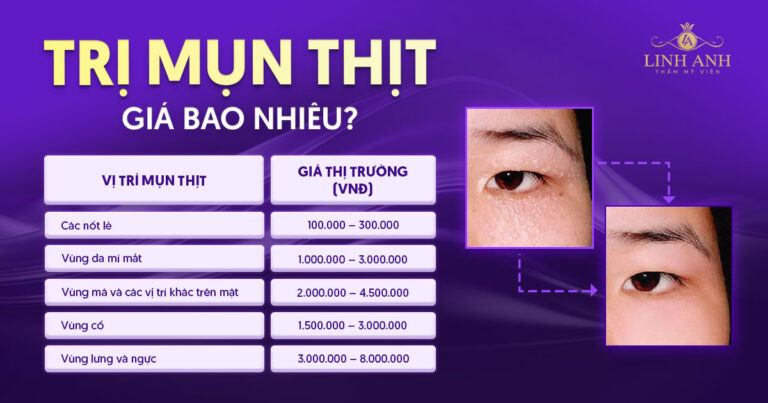 Trị mụn thịt giá bao nhiêu? Đốt mụn thịt quanh mắt có mắc không?