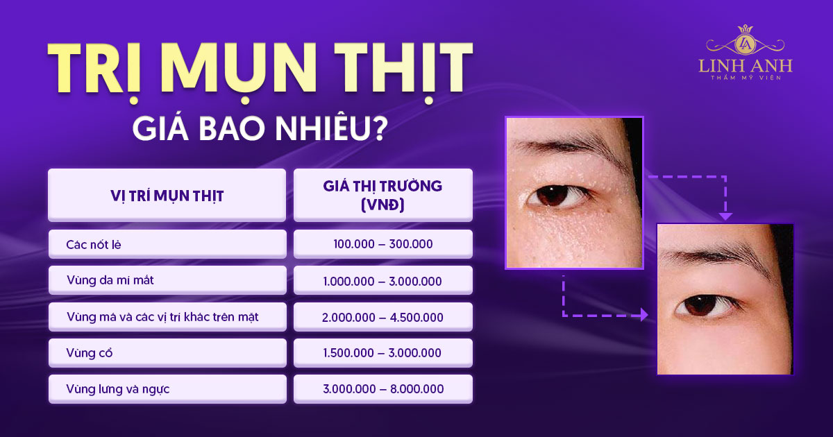 trị mụn thịt giá bao nhiêu