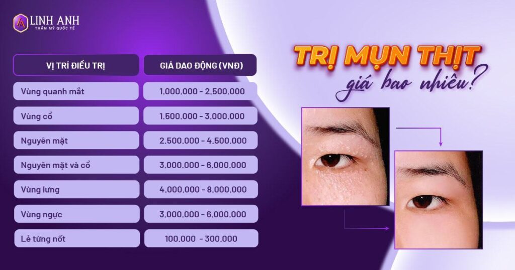 trị mụn thịt giá bao nhiêu - Viện thẩm mỹ quốc tế Linh Anh