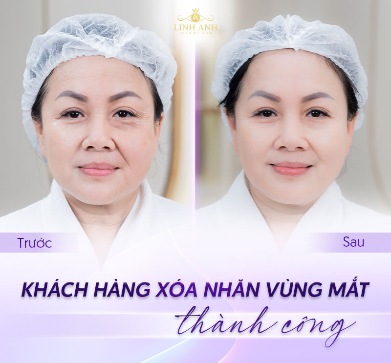 xóa nhăn mắt bao nhiêu tiền xóa nhăn mắt bao nhiêu tiền