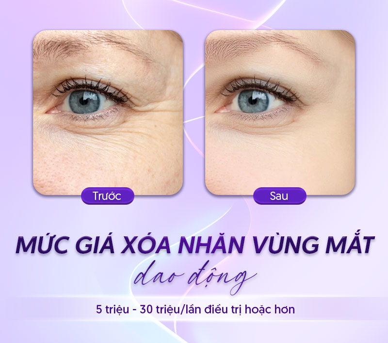 xóa nhăn vùng mắt bao nhiêu tiền xóa nhăn vùng mắt bao nhiêu tiền
