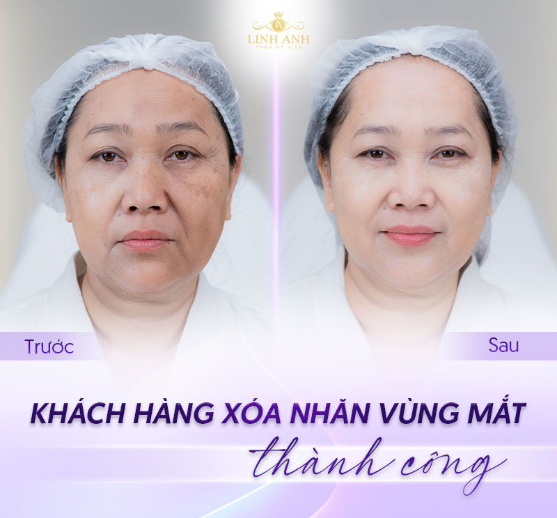xóa nhăn vùng mắt bao nhiêu xóa nhăn vùng mắt bao nhiêu
