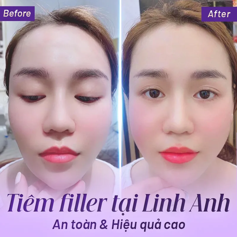 tiêm filler ở đâu an toàn tphcm