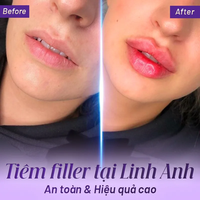 tiêm filler ở đâu an toàn