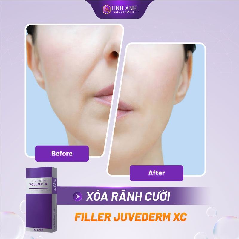 filler juvederm giá bao nhiêu - Thẩm mỹ Quốc tế Linh Anh bảng giá filler juvederm