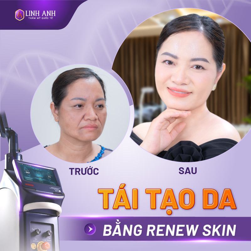 công nghệ renew skin trẻ hóa da
