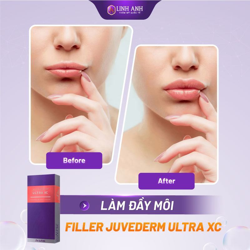 giá tiêm filler juvederm - Thẩm mỹ Quốc tế Linh Anh filler juvederm bao nhiêu tiền