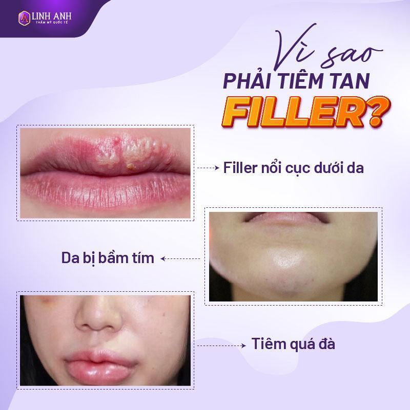 giá tiêm tan filler