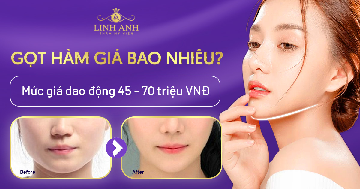 Bảng giá gọt hàm bao nhiêu tiền? Yếu tố ảnh hưởng đến chi phí gọt hàm