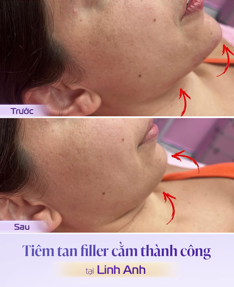 Hình ảnh tiêm tan cằm bị sưng