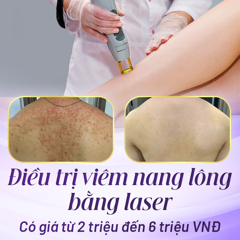 laser trị viêm nang lông bao nhiêu tiền