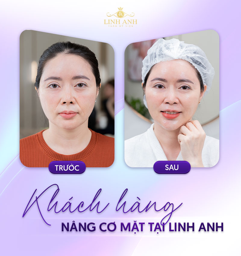nâng cơ mặt bao nhiêu tiền nâng cơ mặt bao nhiêu tiền