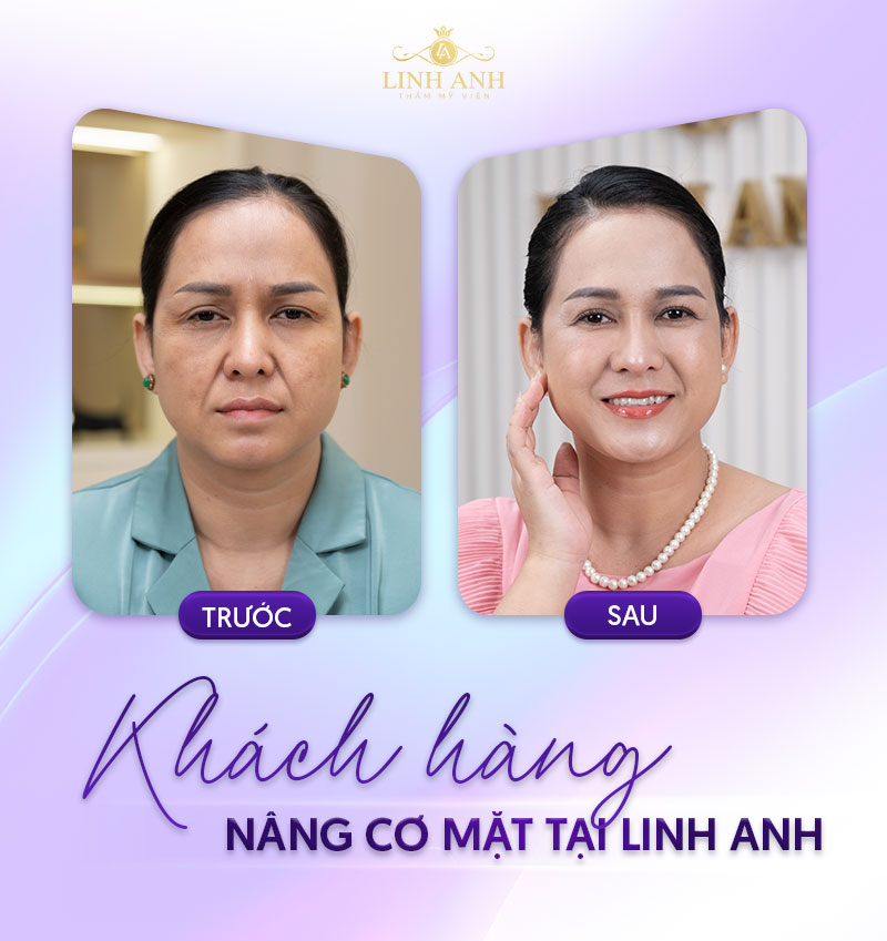 nâng cơ trẻ hoá da mặt bao nhiêu tiền nâng cơ trẻ hoá da mặt bao nhiêu tiền