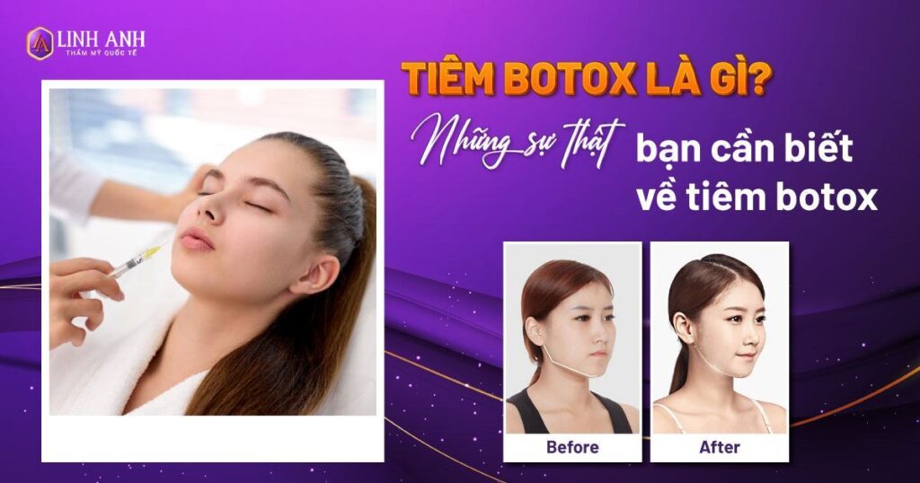 tiêm botox - Viện thẩm mỹ quốc tế Linh Anh