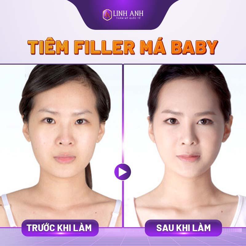 tiêm filler má baby - Thẩm mỹ Quốc tế Linh Anh tiêm filler má hóp