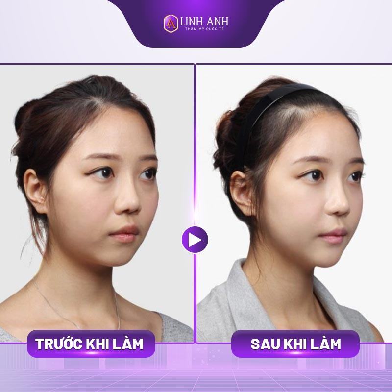 tiêm má baby - Thẩm mỹ Quốc tế Linh Anh tiêm filler má