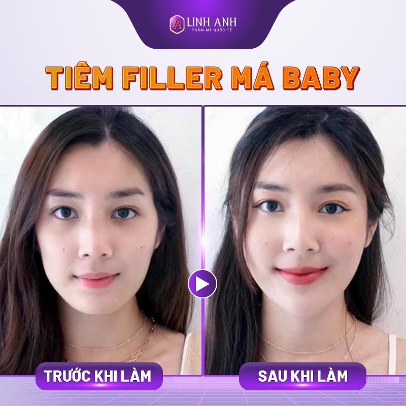 tiêm filler má baby - Thẩm mỹ Quốc tế Linh Anh tiêm má baby bằng filler