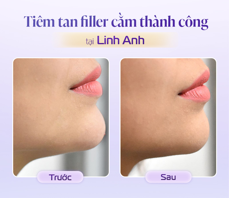 Tiêm tan filler cằm bị nhô