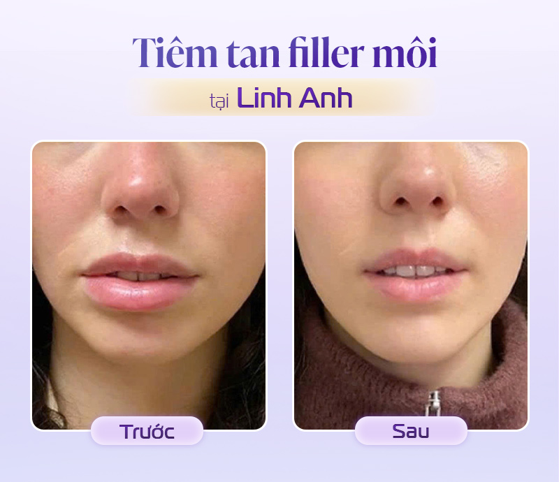 Tiêm tan filler môi bị đau
