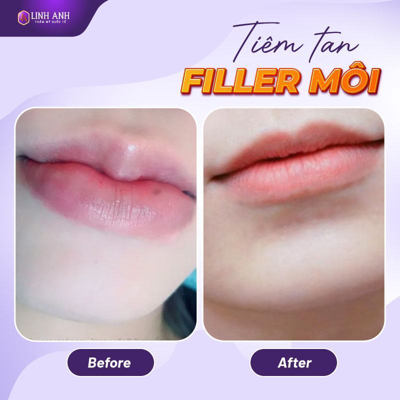 tiêm tan filler môi giá bao nhiêu