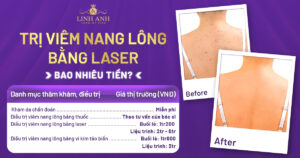 trị viêm nang lông bằng laser bao nhiêu tiền