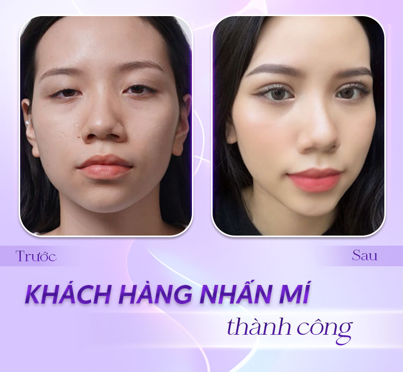 bảng giá nhấn mí bảng giá nhấn mí