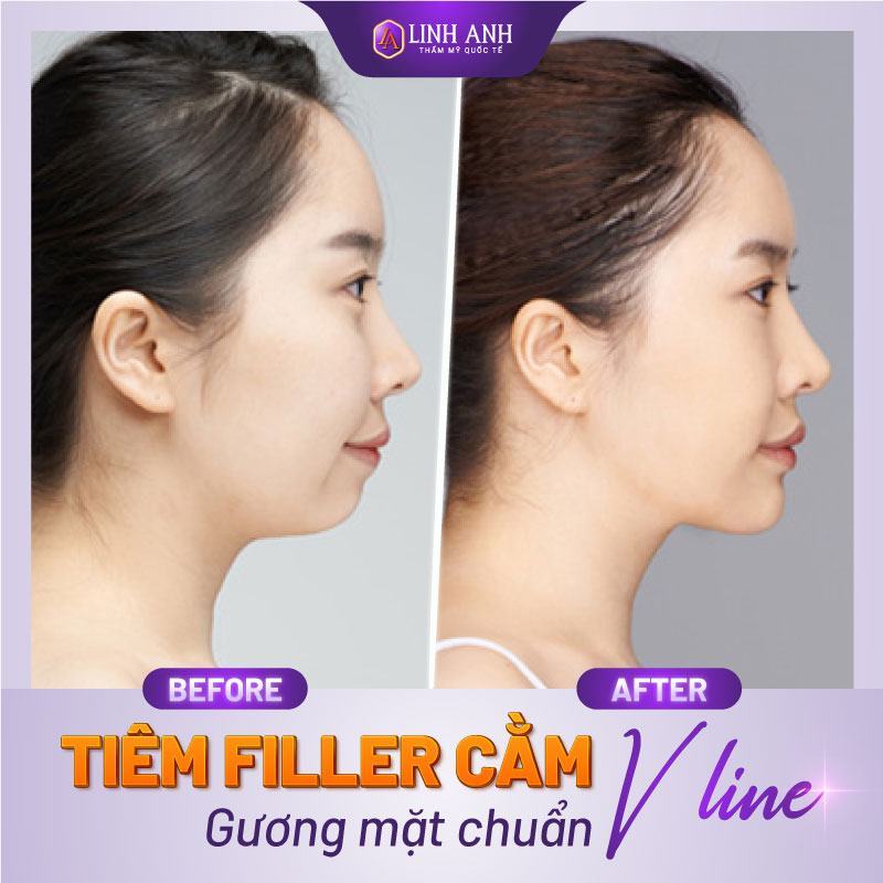 có nên tiêm filler cằm không bảng giá tiêm filler cằm
