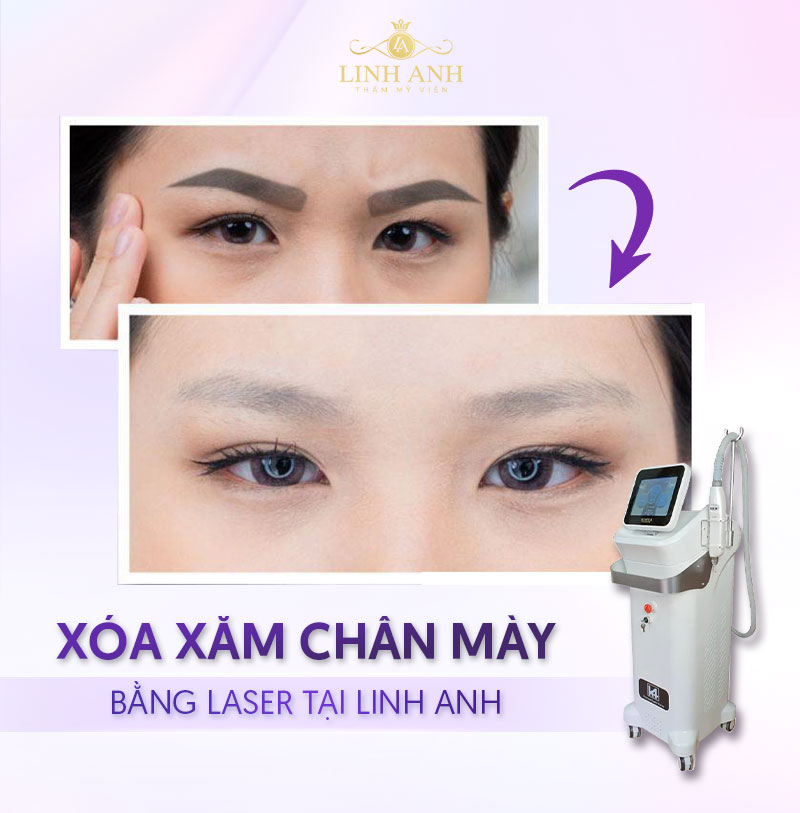 bảng giá xóa xăm ở bệnh viện da liễu bảng giá xóa xăm ở bệnh viện da liễu