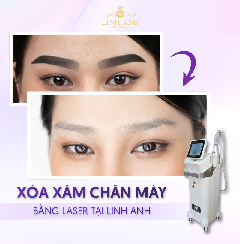 bệnh viện da liễu xóa xăm bao nhiêu tiền bệnh viện da liễu xóa xăm bao nhiêu tiền