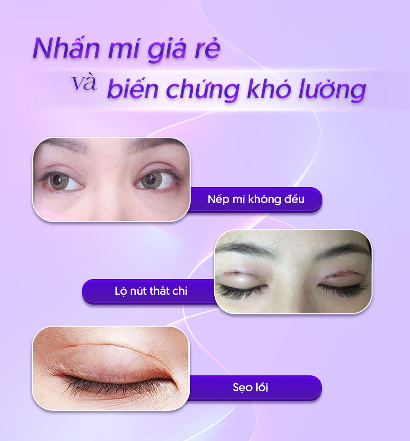 chi phí nhấn mí chi phí nhấn mí