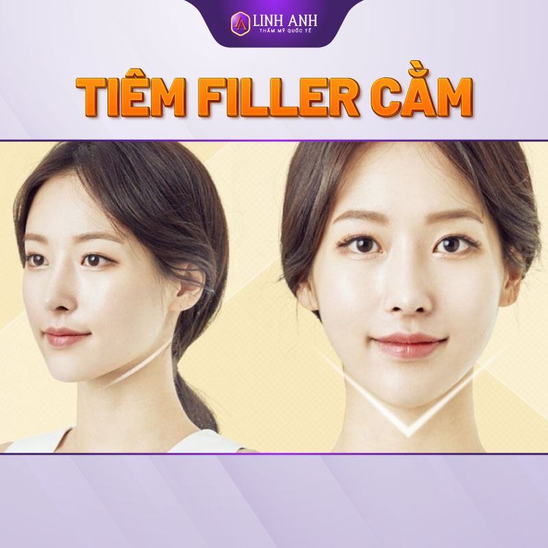 tiêm filler cằm có nên tiêm filler cằm không