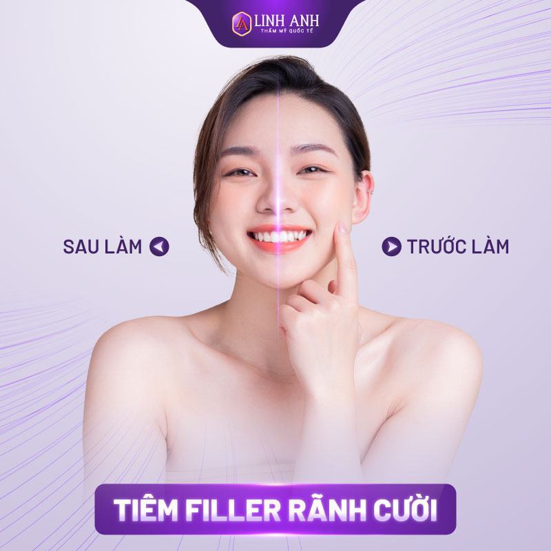 tiêm filler rãnh cười có nên tiêm filler vào rãnh cười