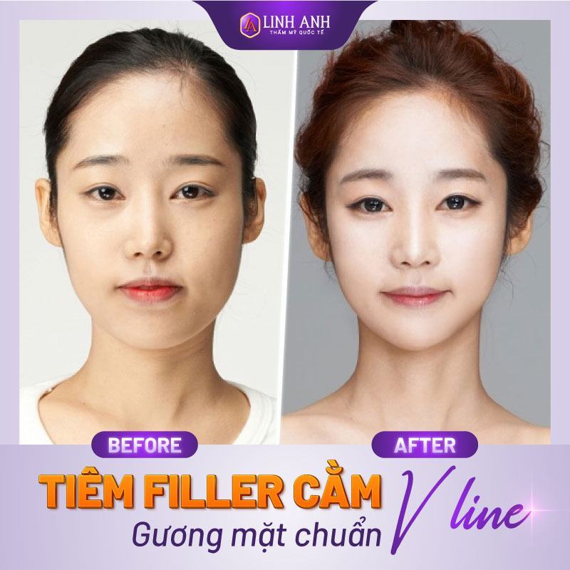 filler tiêm cằm giá tiêm filler cằm