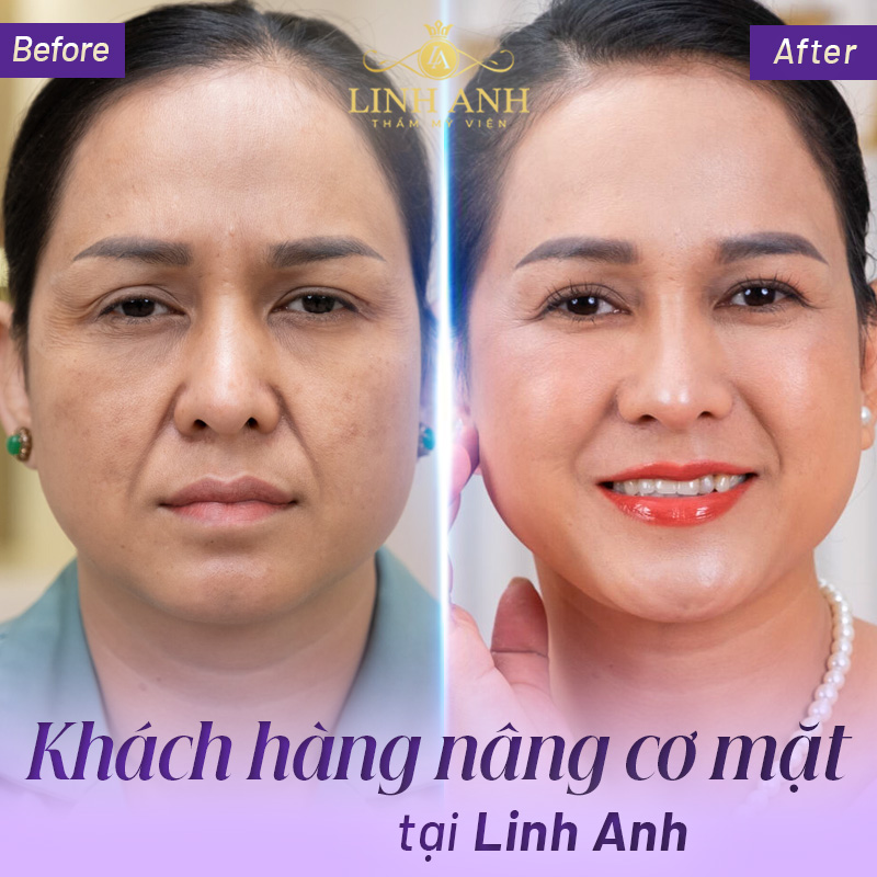 Nâng Cơ Trẻ Hóa Da Hiệu Quả