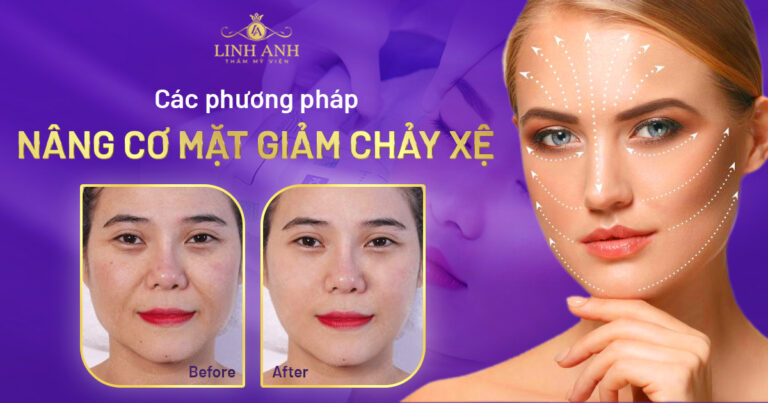 Tổng hợp phương pháp nâng cơ mặt chảy xệ hiệu quả nhất