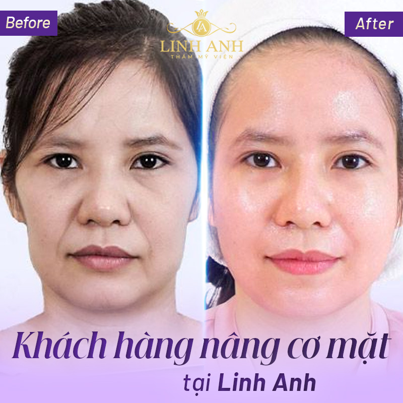 nâng cơ mặt là sao