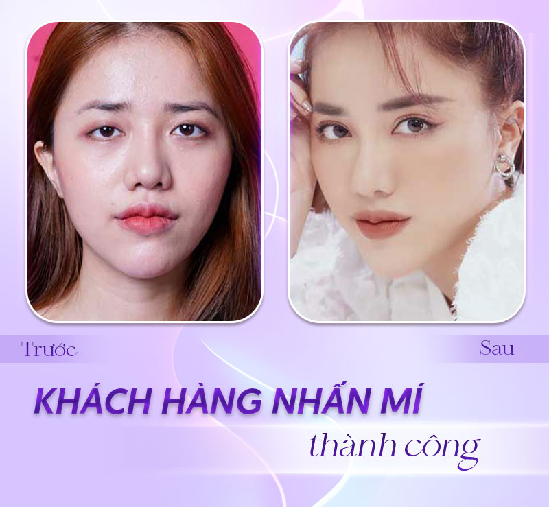 nhấn mí bao nhiêu nhấn mí bao nhiêu