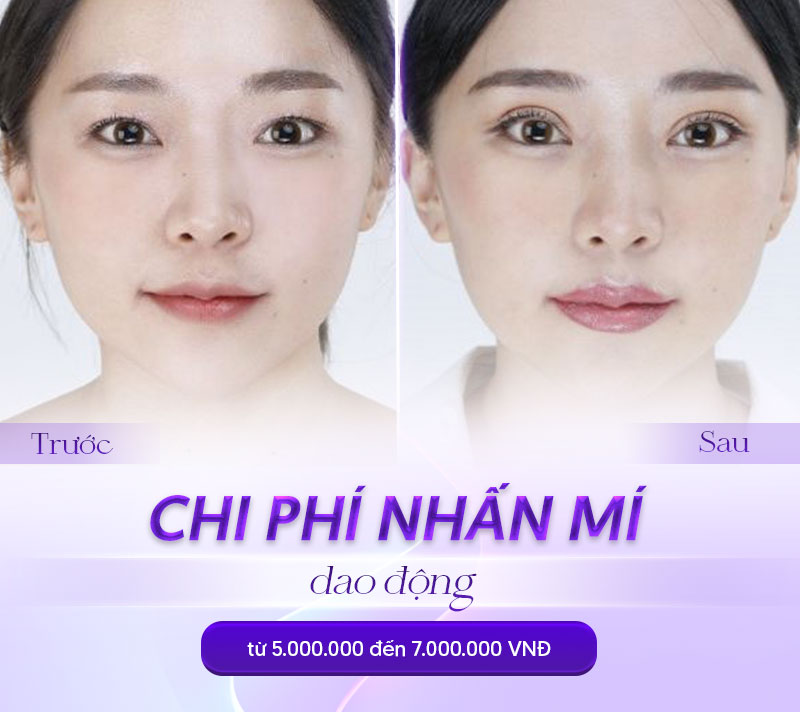 nhấn mí giá bao nhiêu nhấn mí giá bao nhiêu