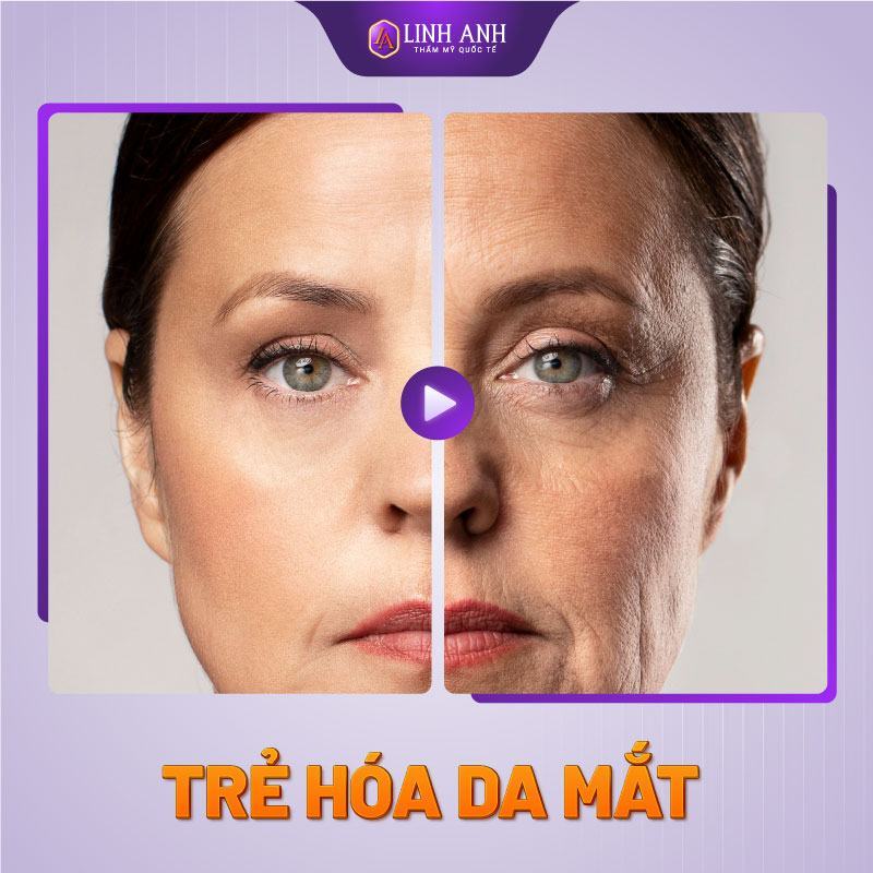 tiêm filler có an toàn không