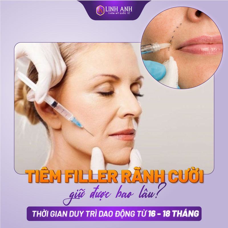 có nên tiêm filler vào rãnh cười tiêm filler rãnh cười được bao lâu