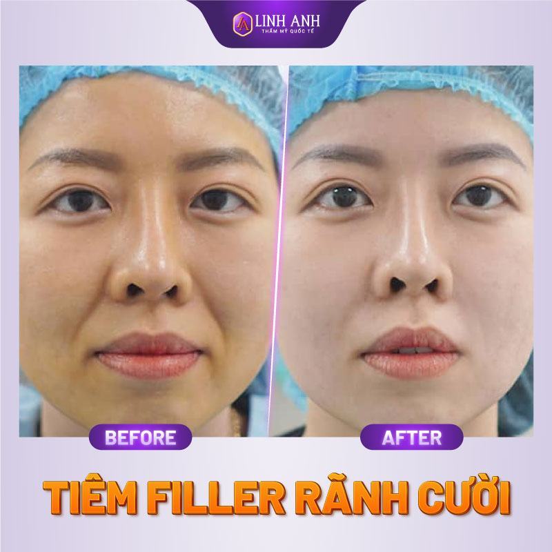 tiêm filler rãnh cười tiêm filler rãnh cười là gì