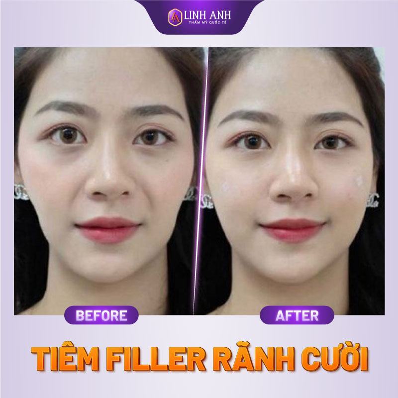 tiêm filler rãnh cười giá bao nhiêu tiêm rãnh cười