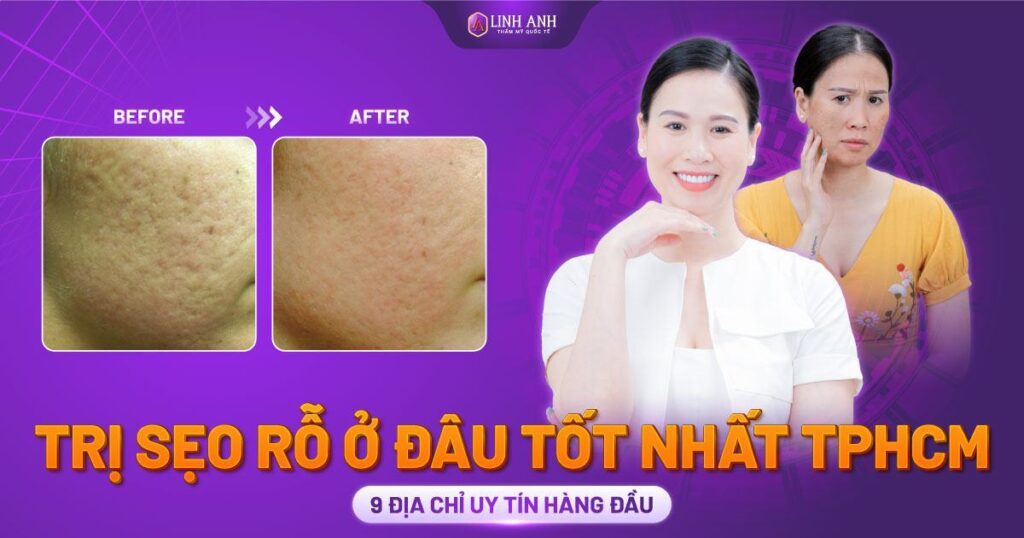 trị sẹo rỗ ở đâu tốt nhất tphcm