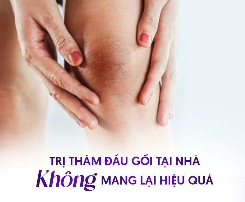 chi phí trị thâm đầu gối chi phí trị thâm đầu gối