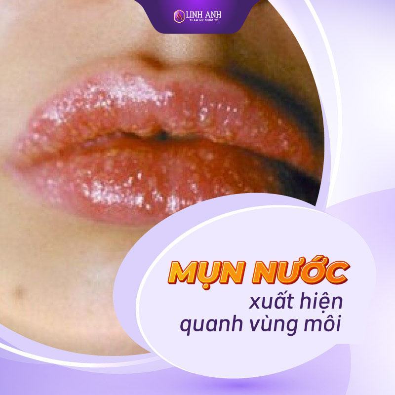 Dấu hiệu chứng tỏ phun môi bị hỏng và cách khắc phục hiệu quả
