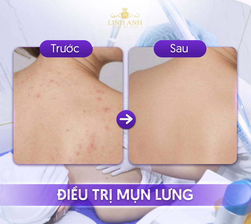 điều trị mụn lưng tại spa điều trị mụn lưng tại spa