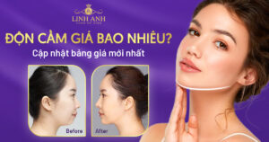 độn cằm giá bao nhiêu