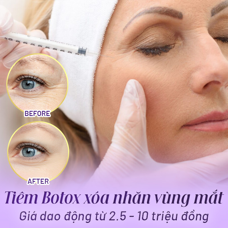 giá tiêm botox vùng mắt