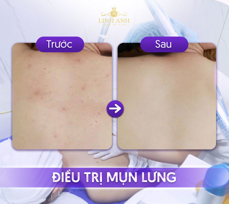 giá trị mụn lưng giá trị mụn lưng