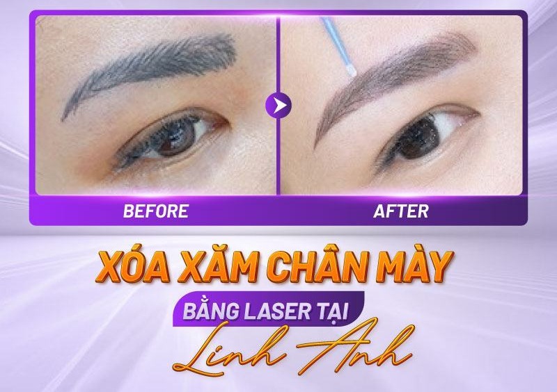 hình ảnh xóa xăm chân mày hình ảnh xóa xăm chân mày